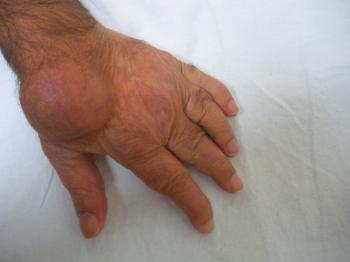 Romatoid Artrit Tedavisinde Yenilikler