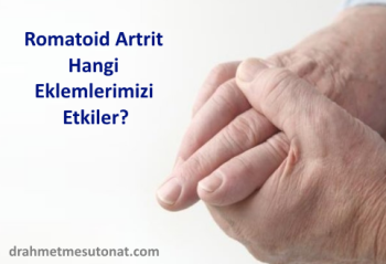 Romatoid Artrit Hangi Eklemlerimizi Etkiler?